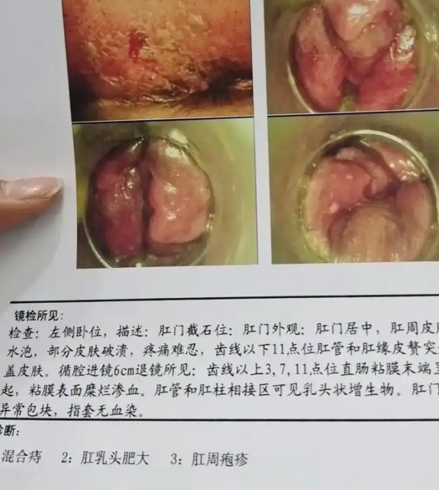肛门旁边长了个小肉赘,最常见的是痔疮,但也可能是肛门息肉,尖锐