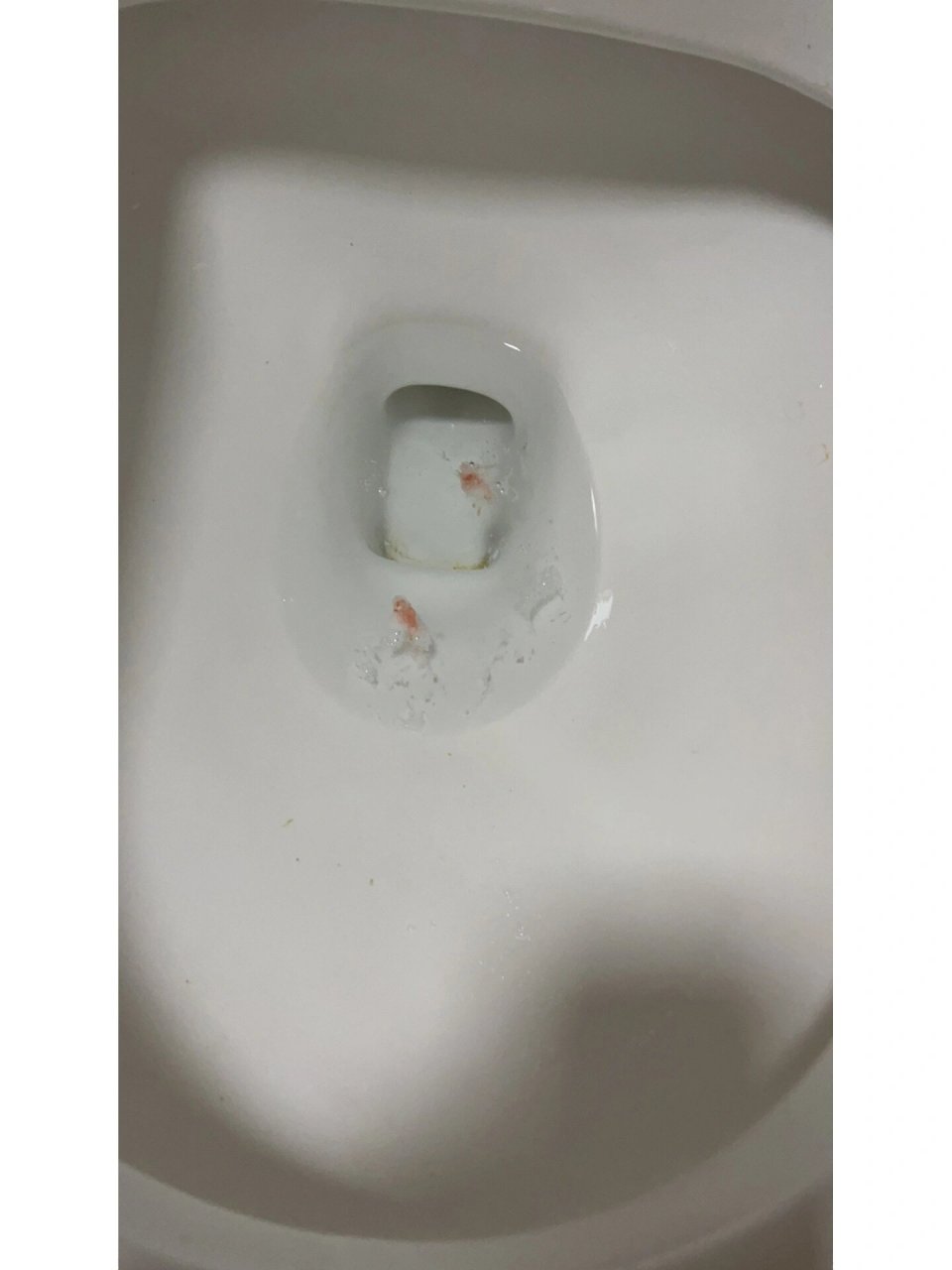 孕吐吐血,什么原因?