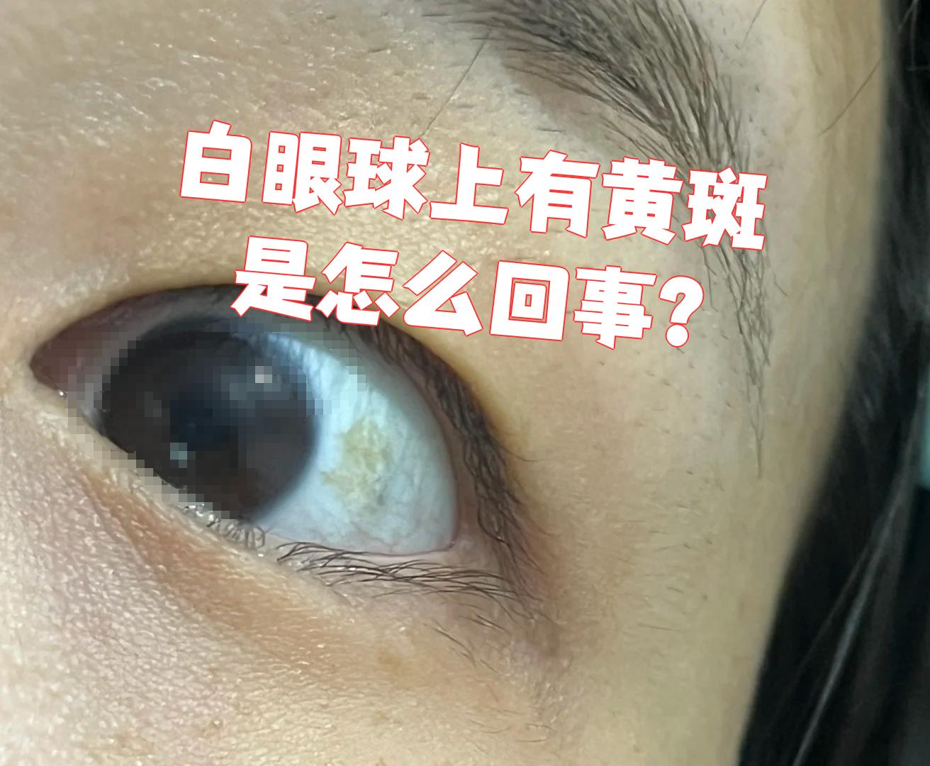 里有黄斑是怎么回事眼白发黄白眼球上有黄色斑块怎么回事眼睛黄斑黄斑