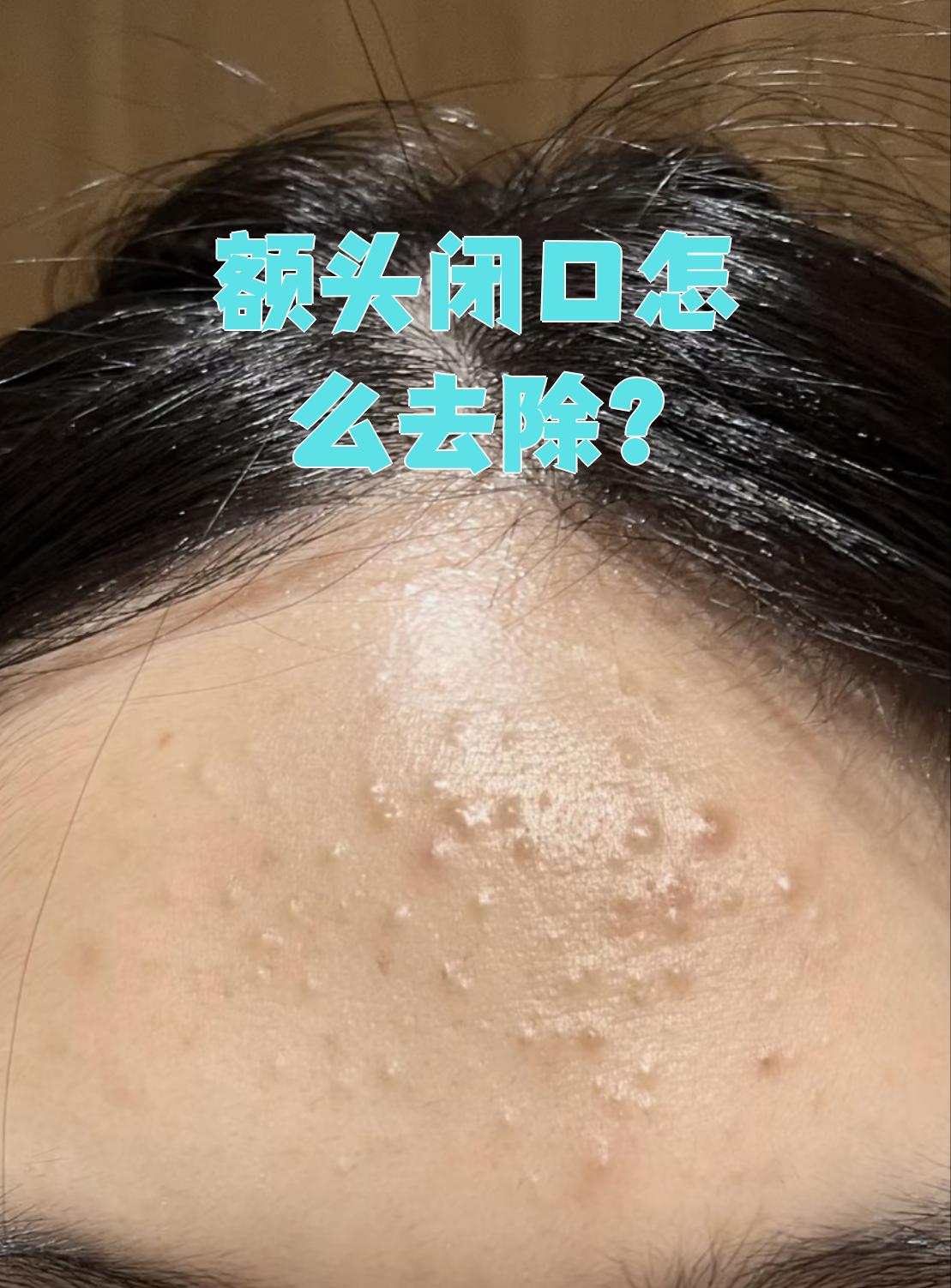 额头闭口就是闭口粉刺,想要去除它可以从三个方面入手:调整饮食