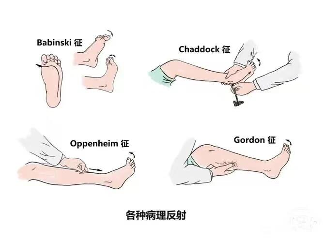 babinski sign图片