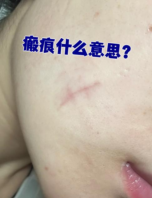 瘢痕就是皮肤受伤愈合后留下的疤