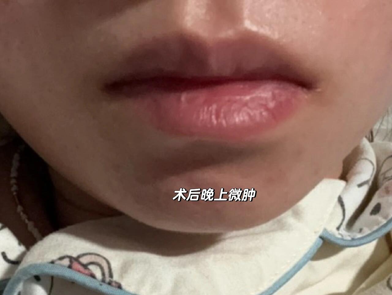 粘液腺囊肿别害怕!