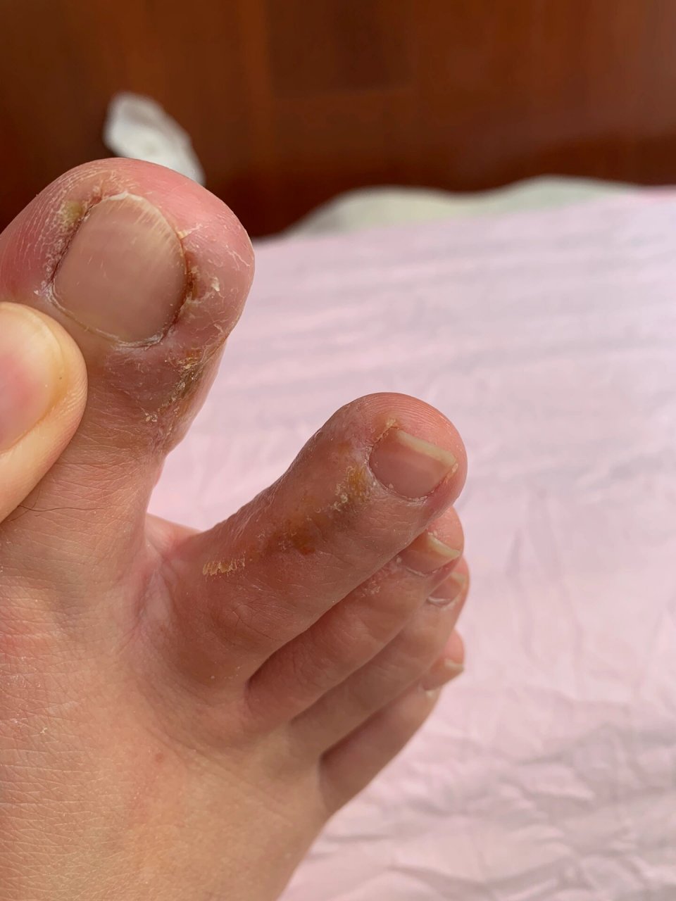 甲沟炎好转最有效的办法就是不管它!