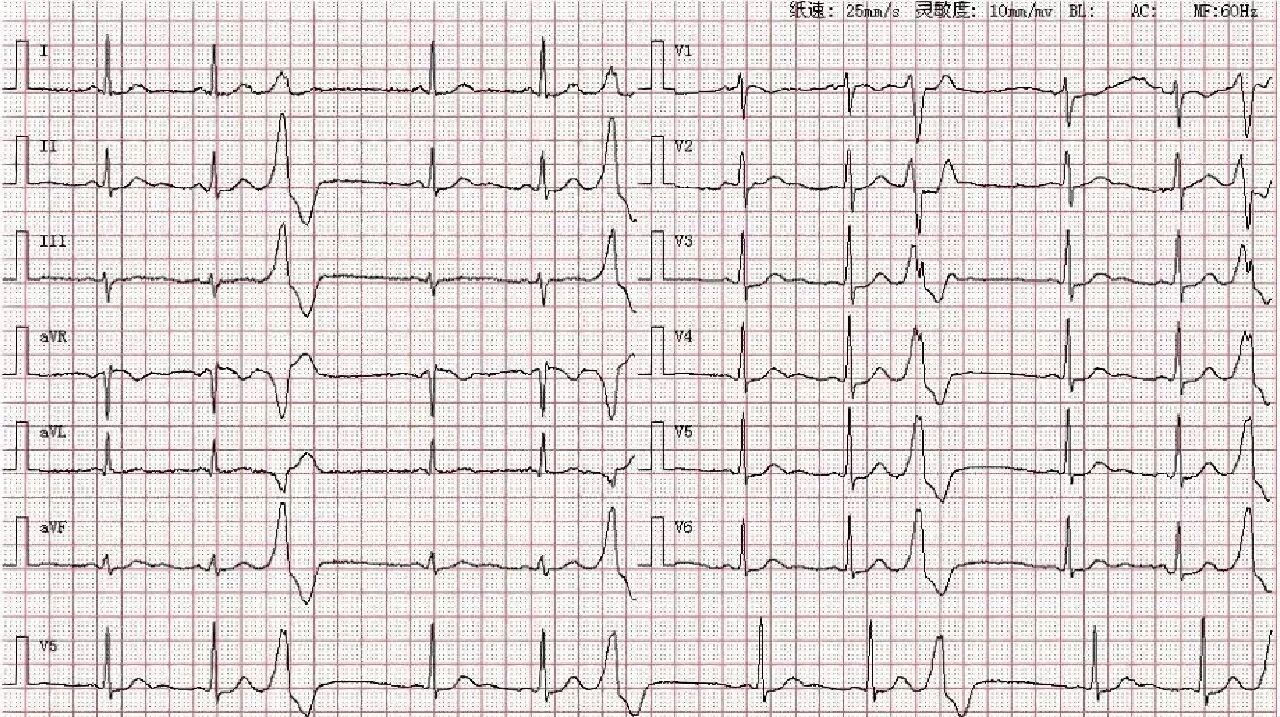 频发性室性早搏图片图片