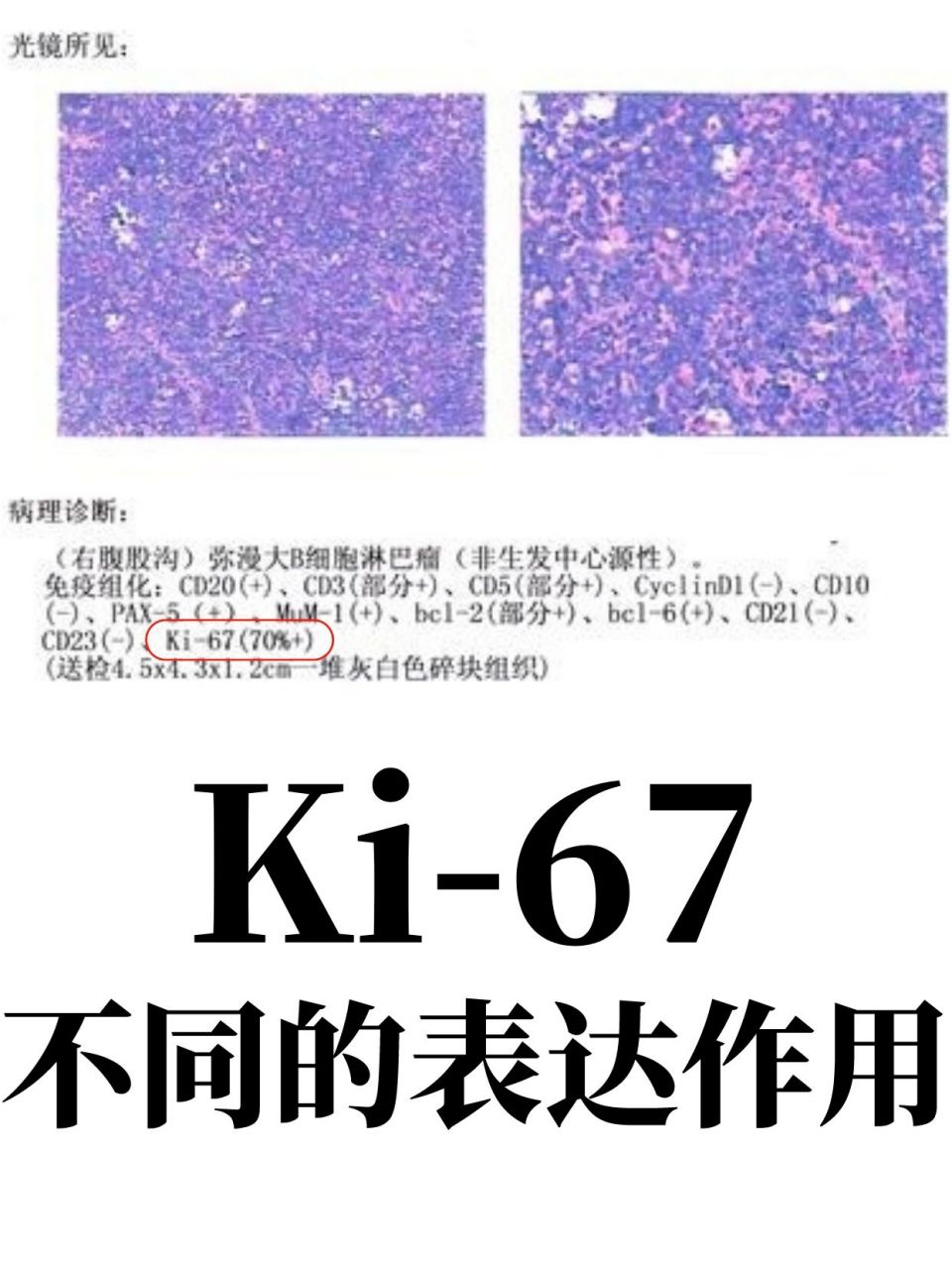 ki-67越高预后越不好吗?