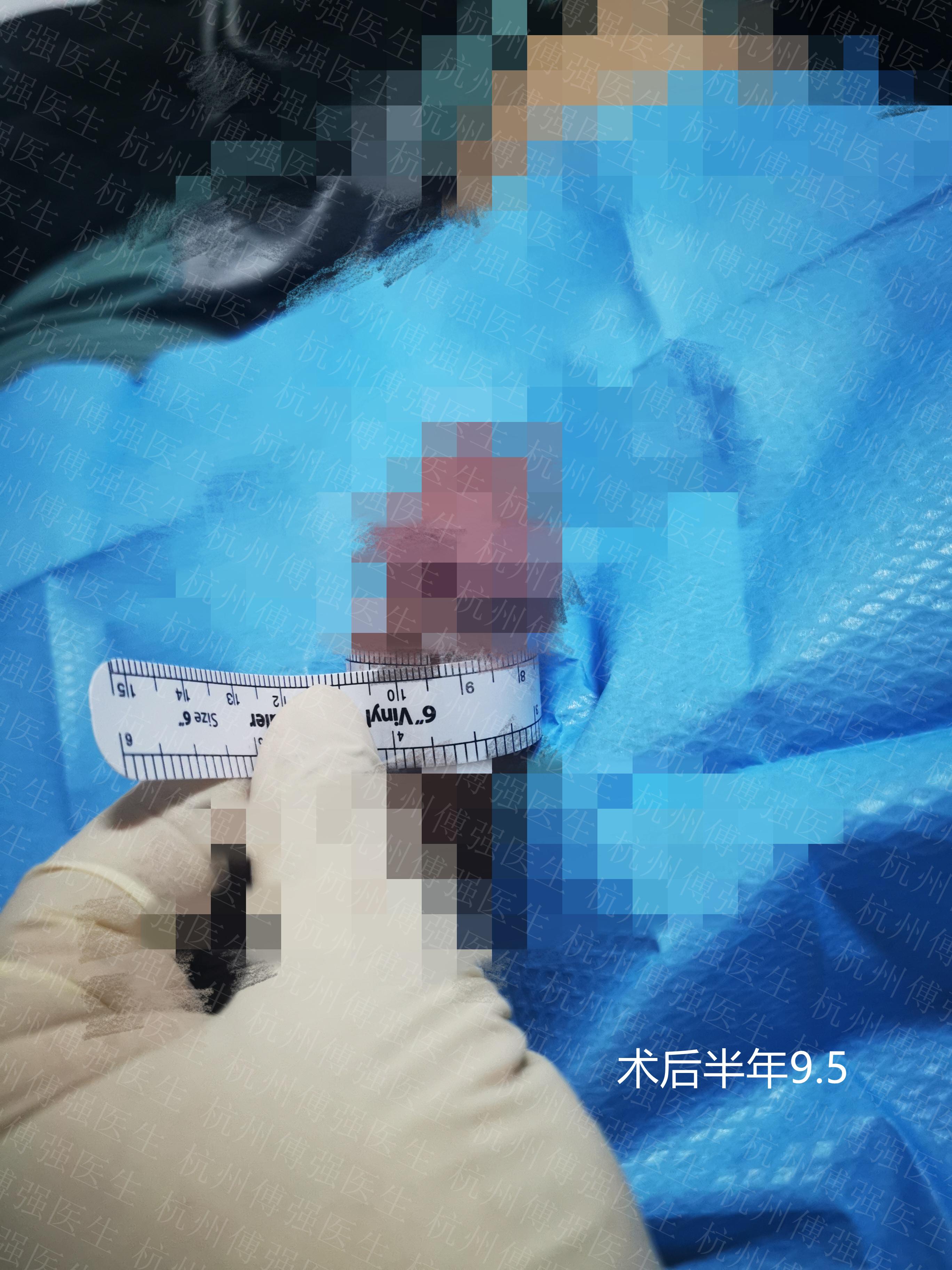 知乎用户gp5y7s 的想法: 【包皮真皮剥脱增粗术案例】暑期将至,割包皮