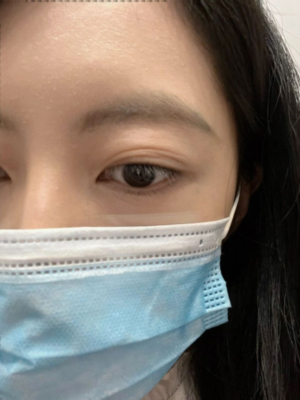 三眼皮多眼皮怎么两步恢复双眼皮 一觉醒来双眼皮变成了好多层眼皮