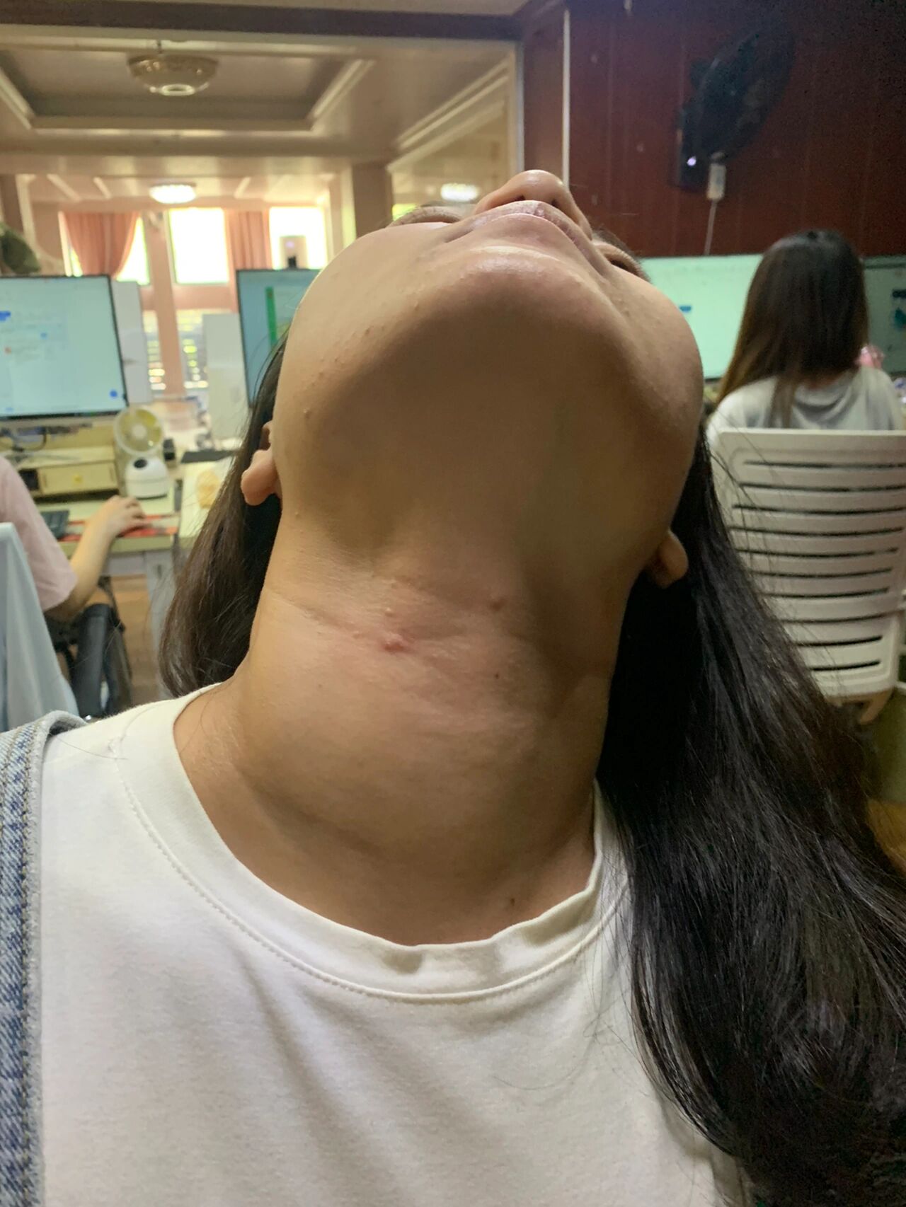 甲亢脖子粗 真的好粗壮,挺尴尬的