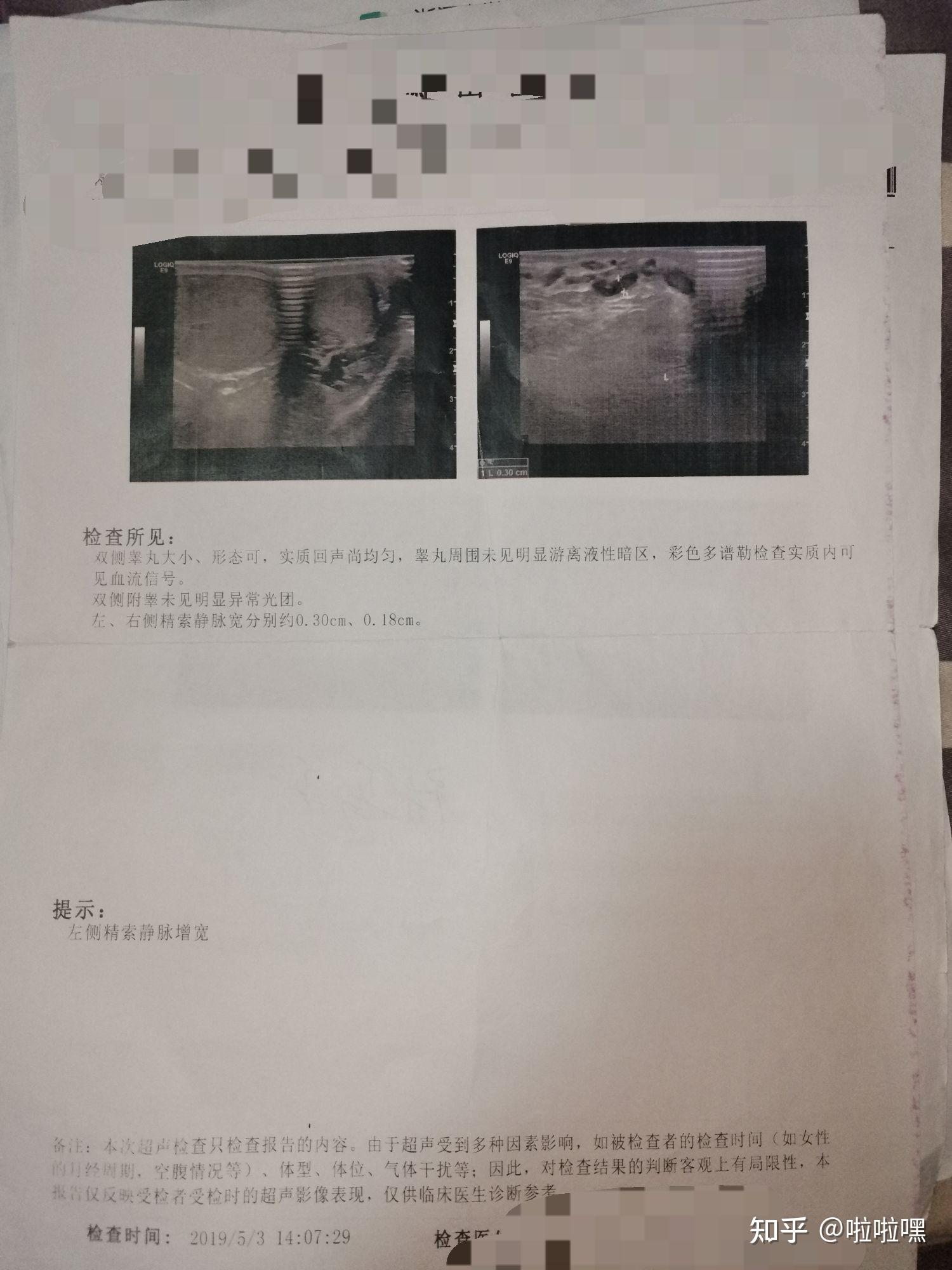 精索静脉曲张是什么体验