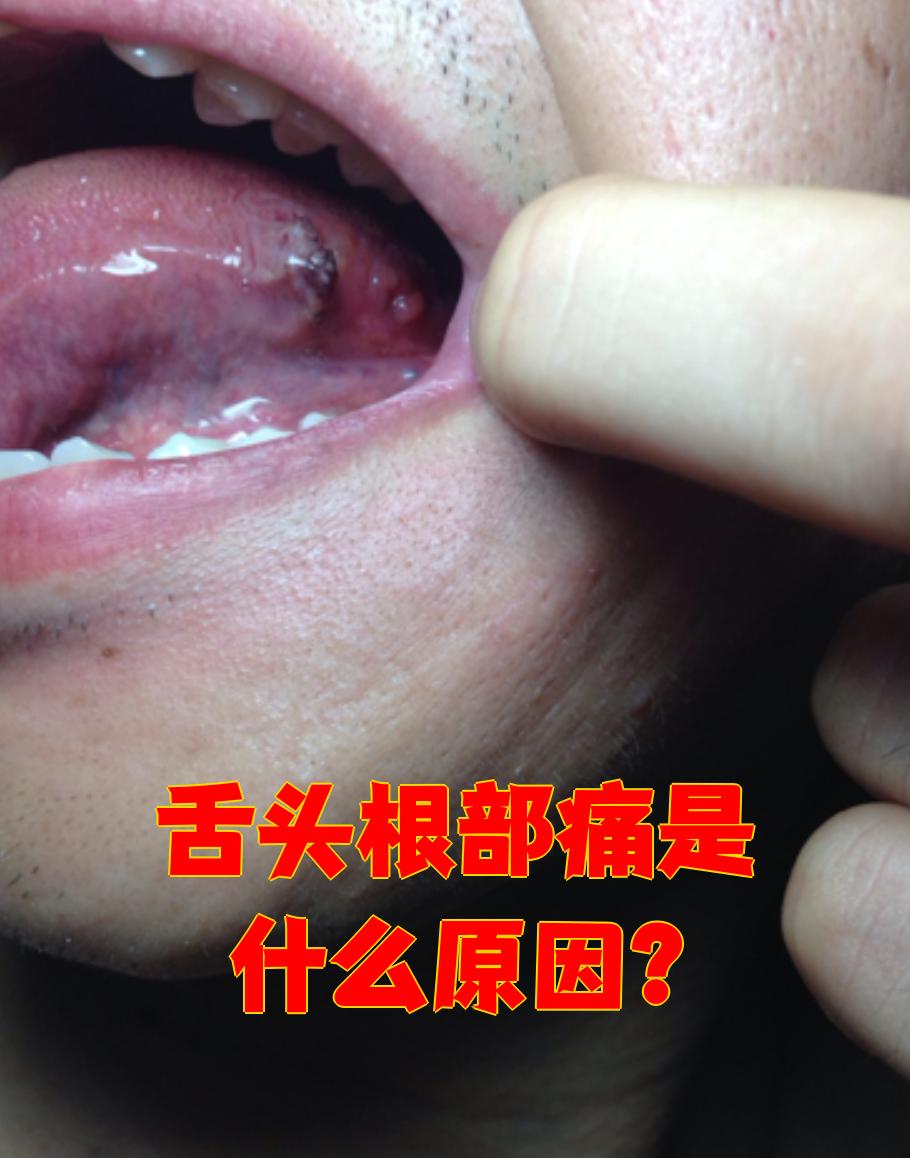 第一,溃疡可能导致舌根痛
