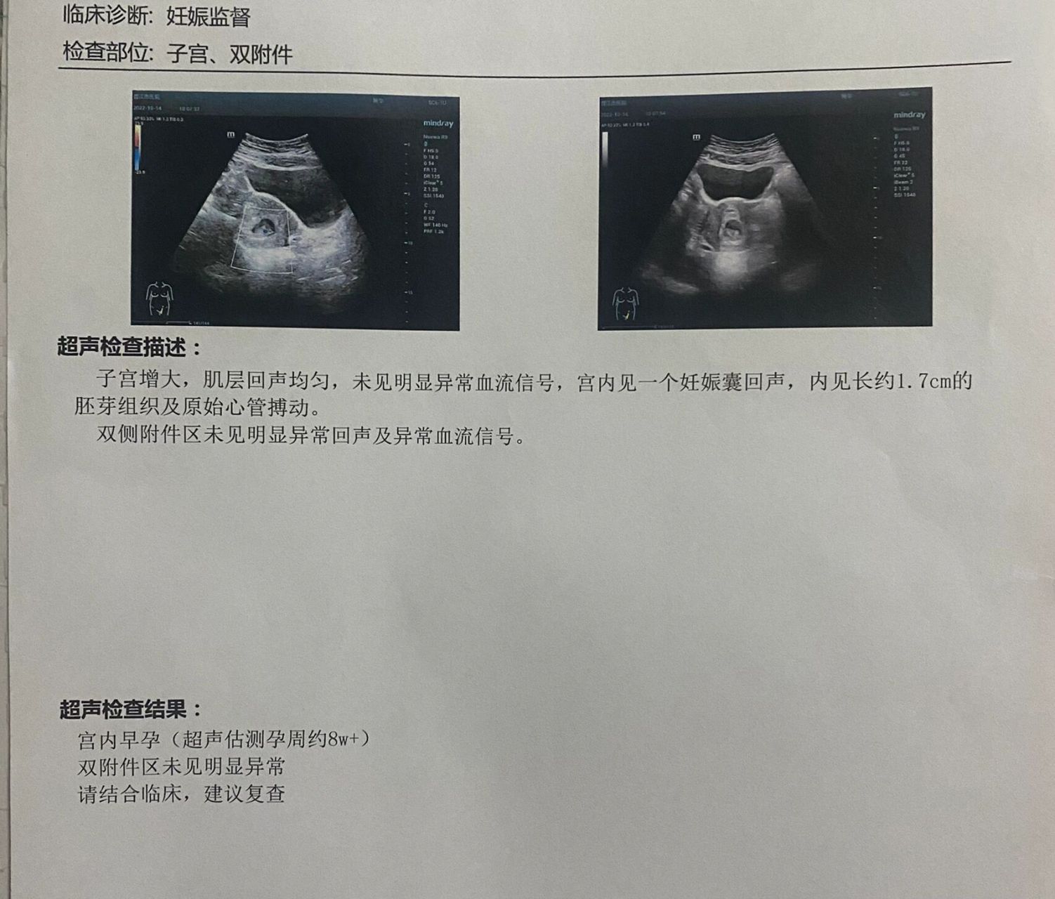 10月7日b超显示偏左侧宫角妊娠,医生都准备把我扣下来住院了,跟我说