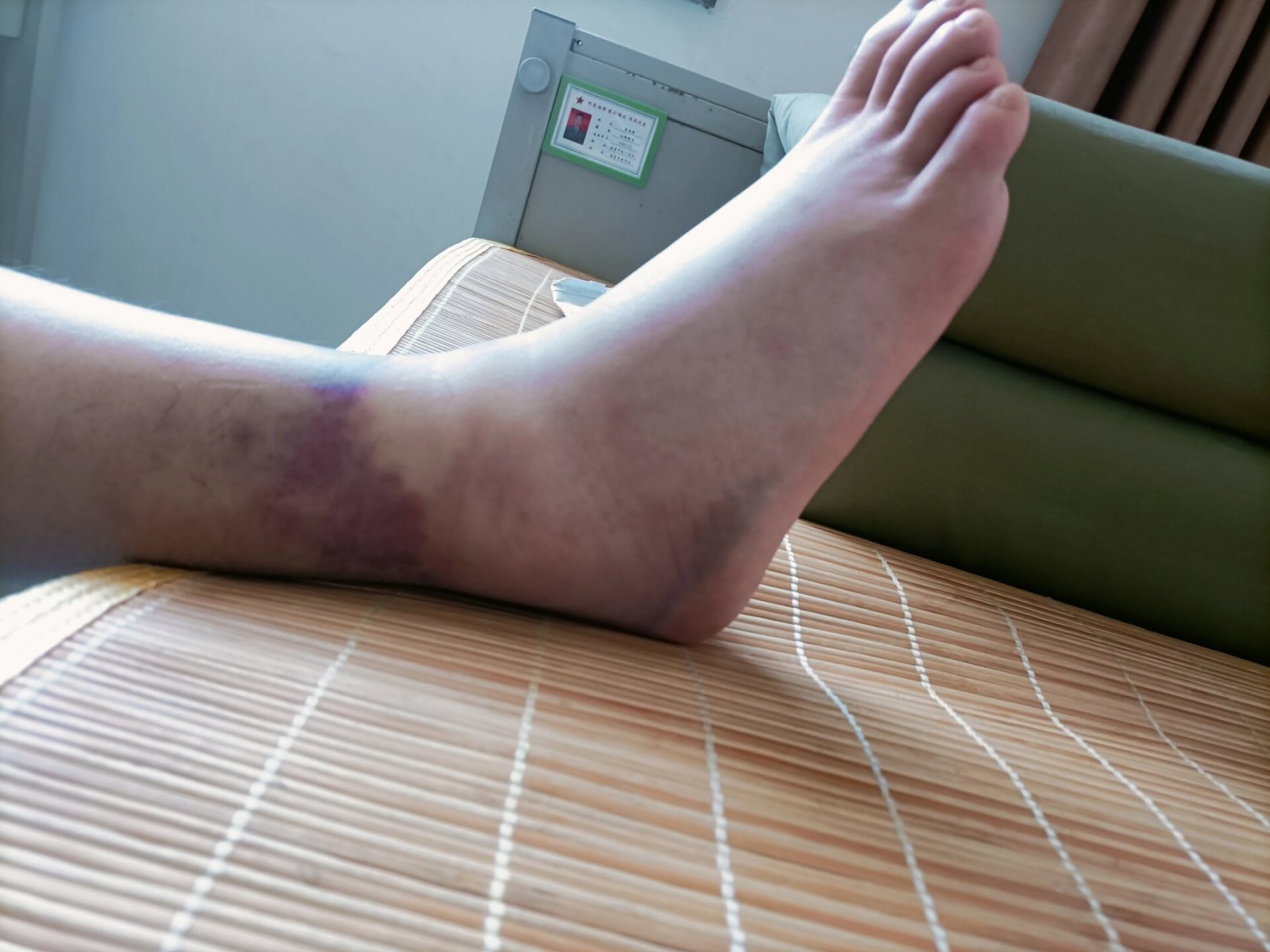 崴脚 肿胀 积血 19号周六崴的脚,去了医院,简单拍了x光,骨头没事.