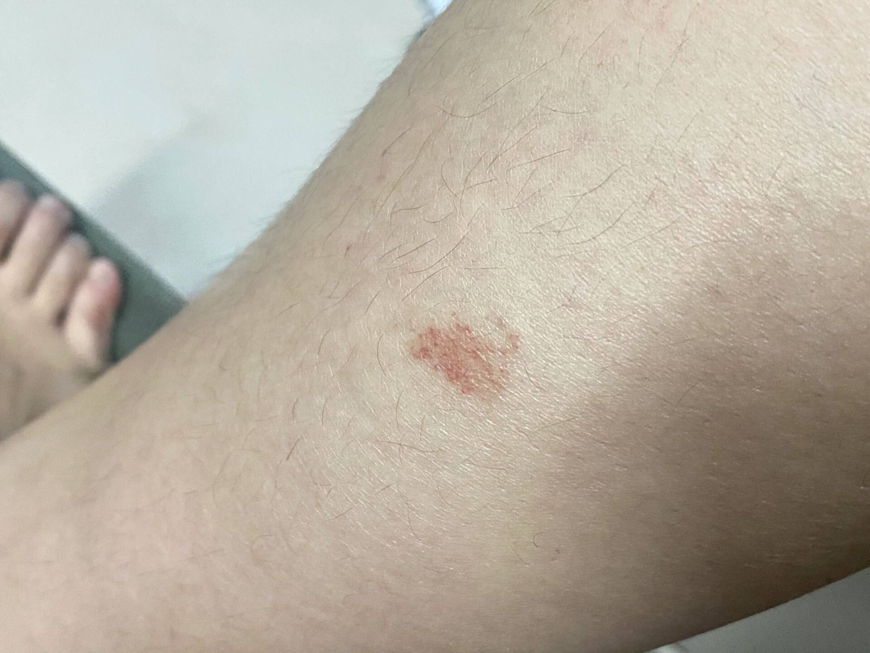 腿上莫名其妙有红疹有没有朋友知道 本来两三块红色的 一片红点 不痛