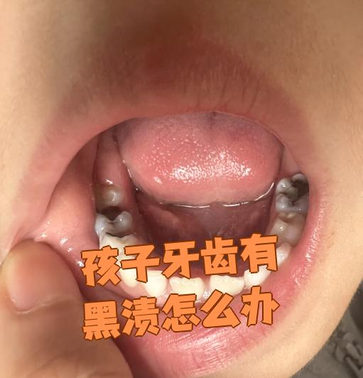 孩子牙齿有黑渍怎么办