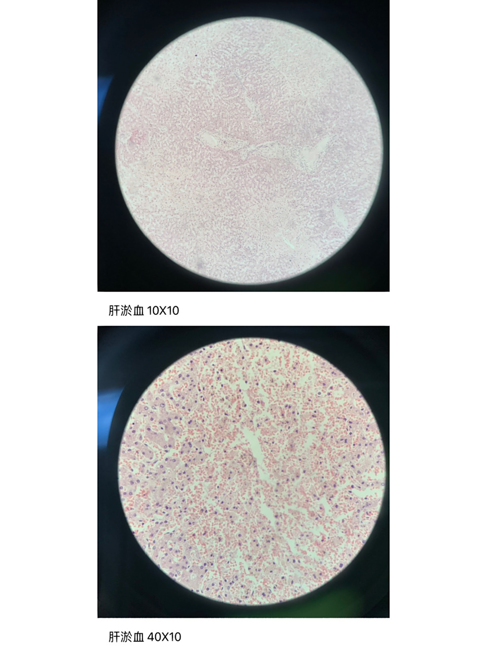 病理学实验报告三 慢性肺淤血