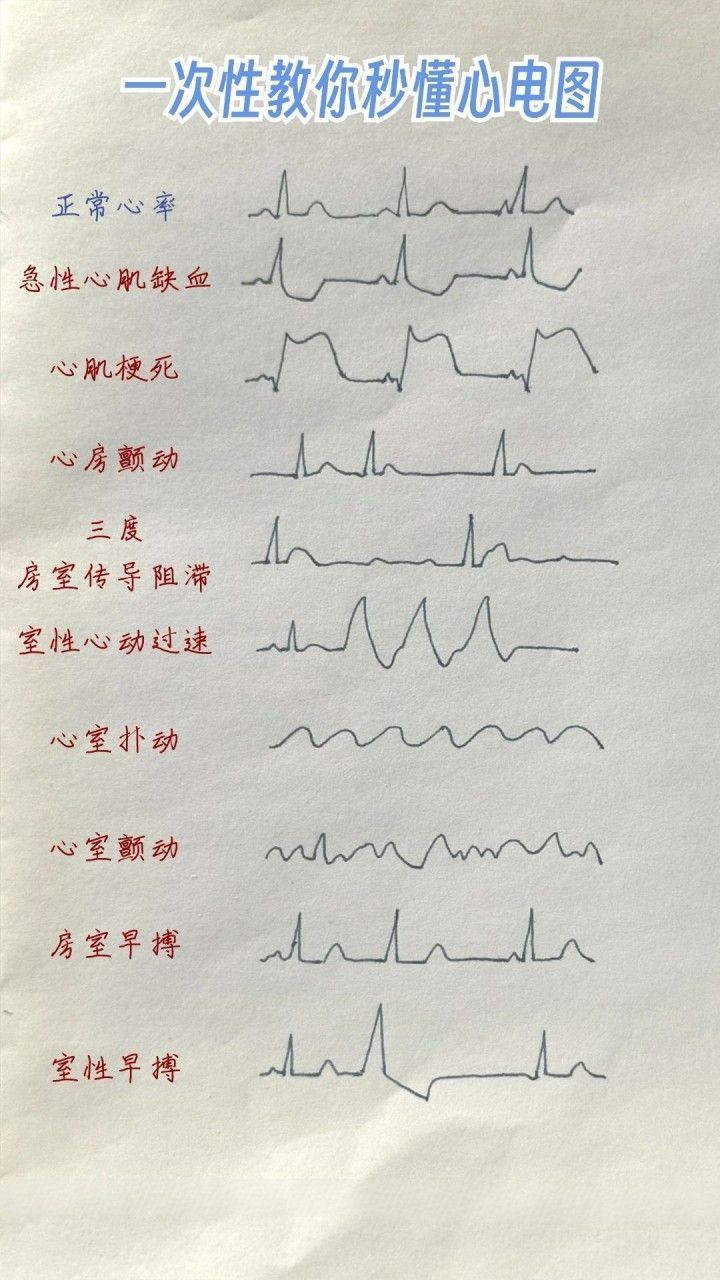 室性早搏心电图特点图片