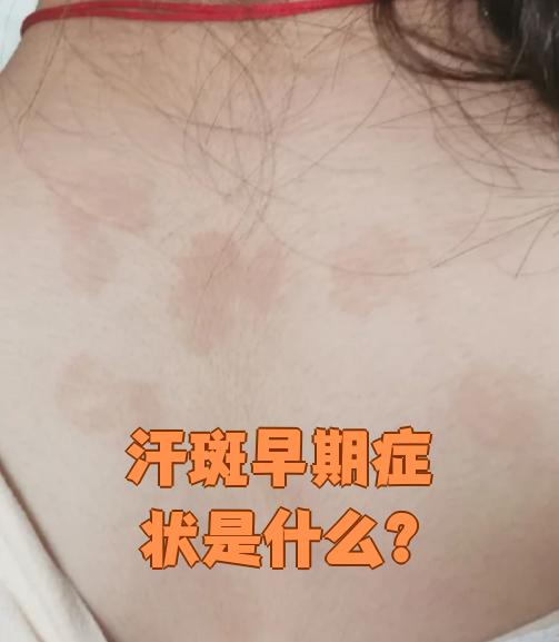 汗斑早期症状通常是皮肤上出现点状斑疹,这些斑疹最常见于胸部,背部
