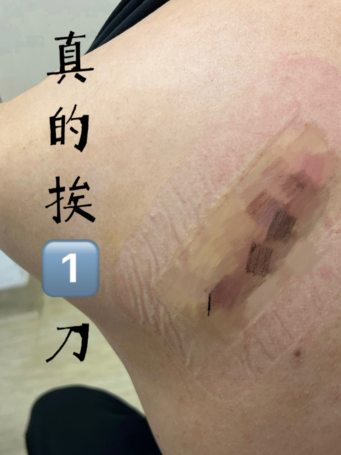 术后食谱|挨一刀 怎么吃?