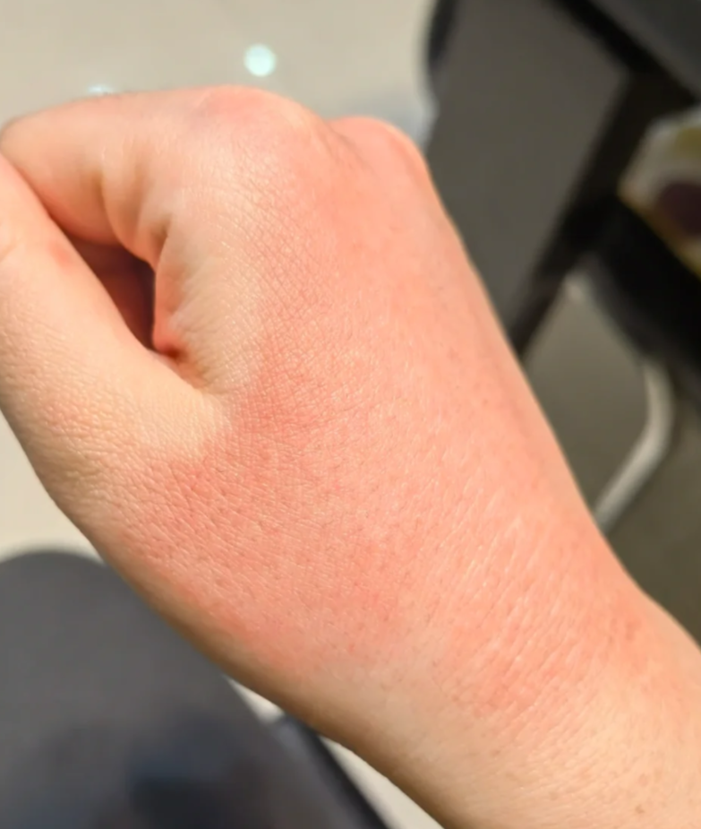 干燥还带刺痛感,最常见的原因是空气太干燥,但也可能是干性湿疹或手癣