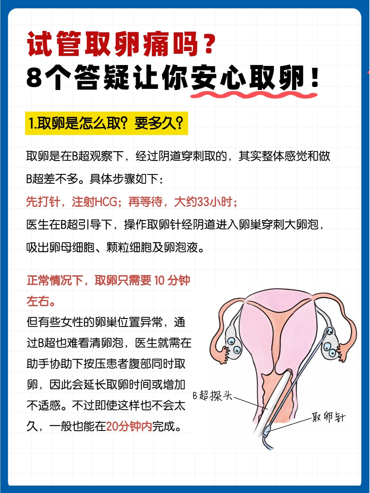 8个你最关心的问题解答 02取卵是做试管婴儿前必不可少的一个过程