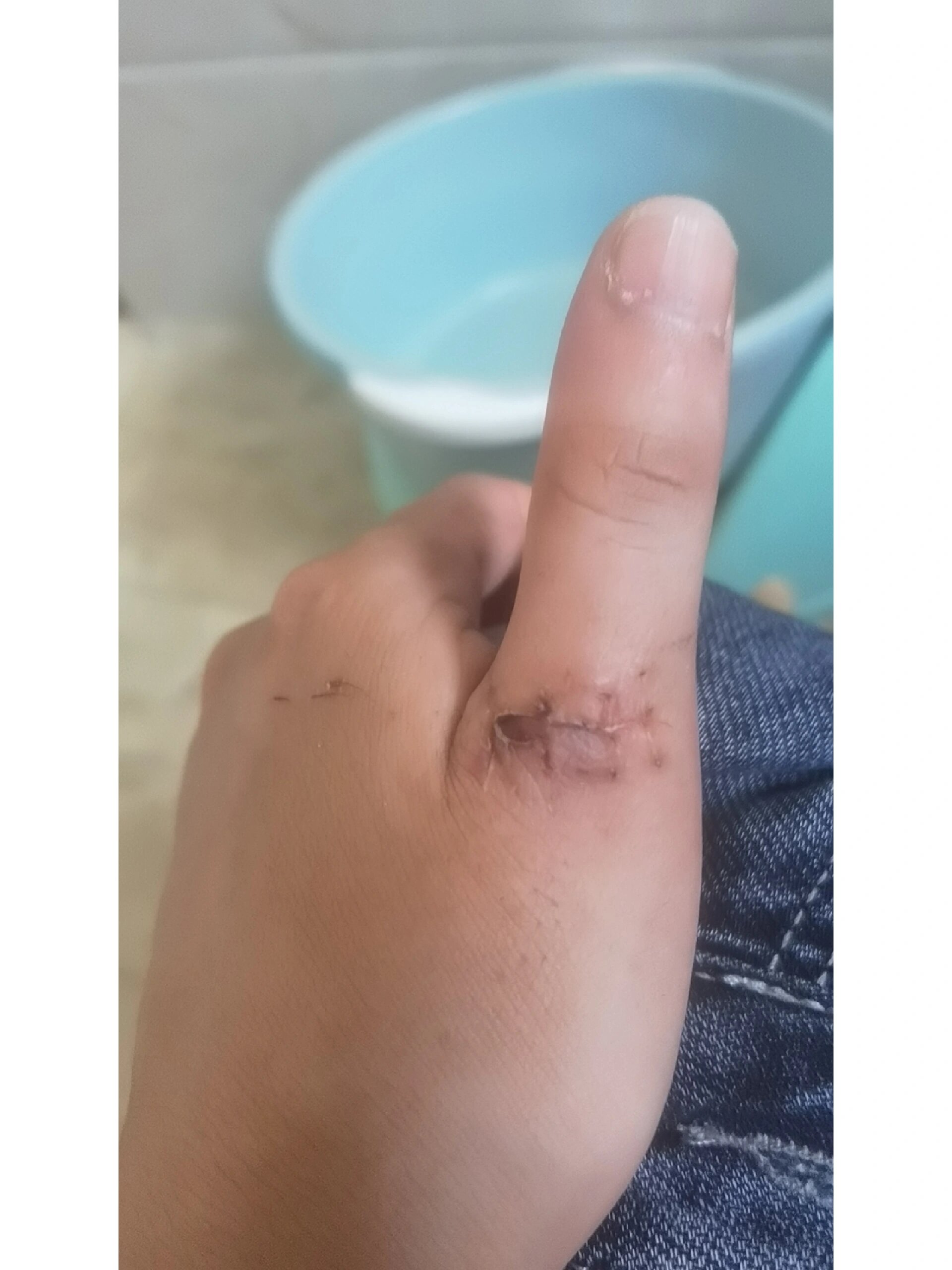 康复第四周,因为手指基本弯不了,担心粘连,开始在家锻炼.