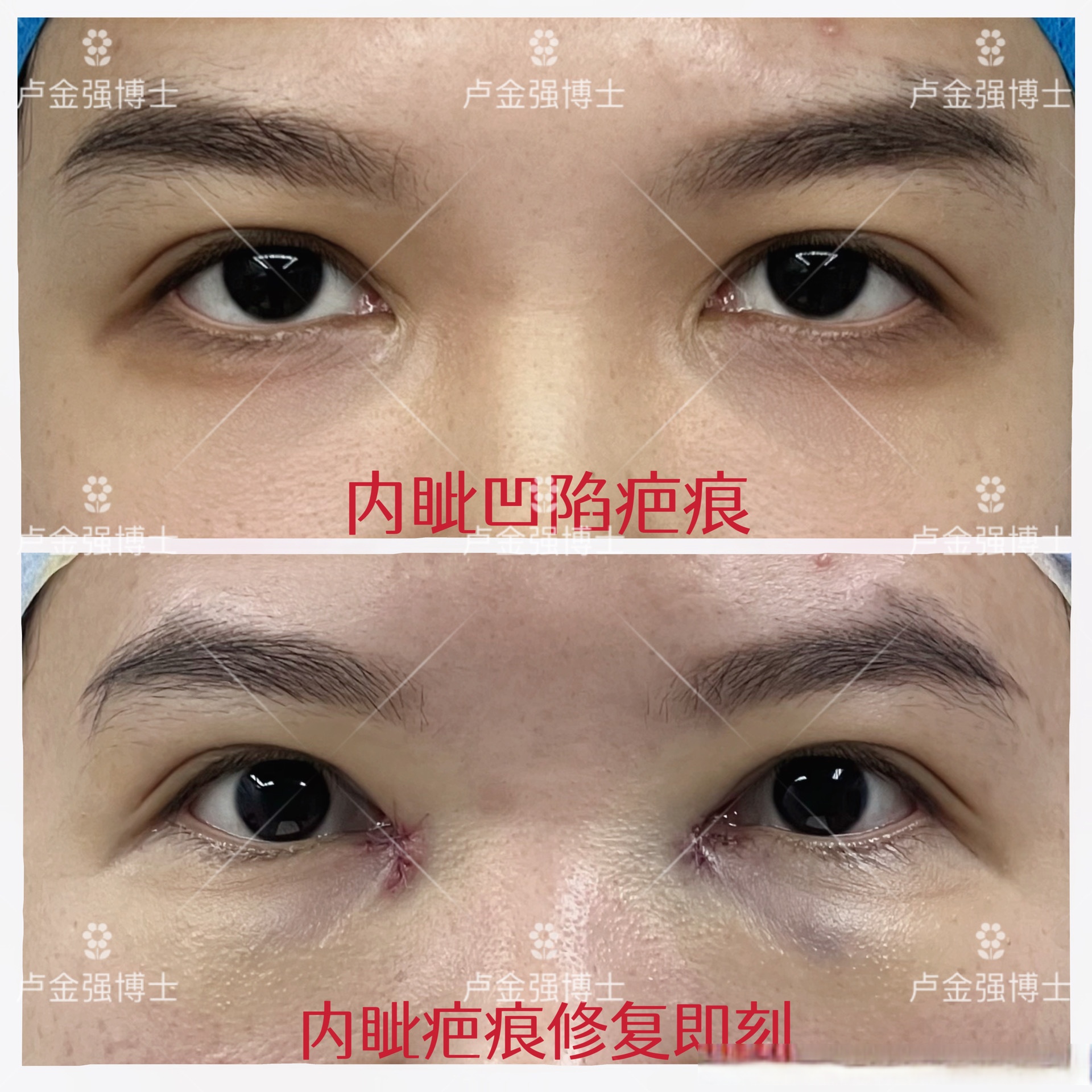 内眼角括弧凹陷疤痕3年,姑娘3年前外院行双侧重睑及内眦手术,术后内眦