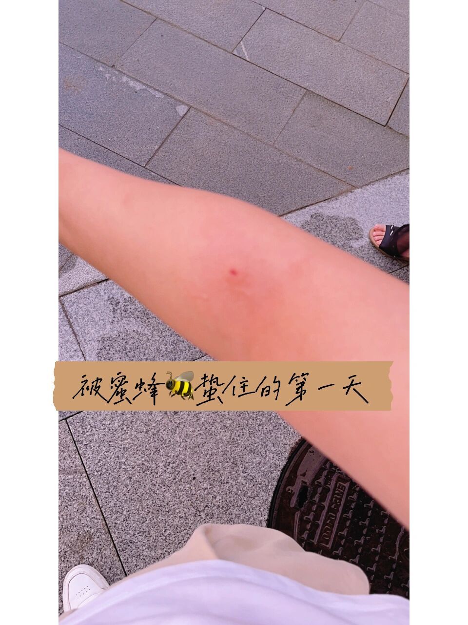 真实体验了一下93蜂蜇伤 被一只小蜜蜂蛰住了胳膊,第一反应赶紧把刺