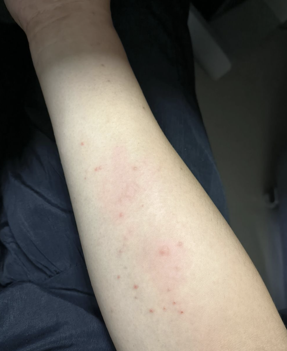 手臂上长了小红点不痛不痒怎么回事怎么办?