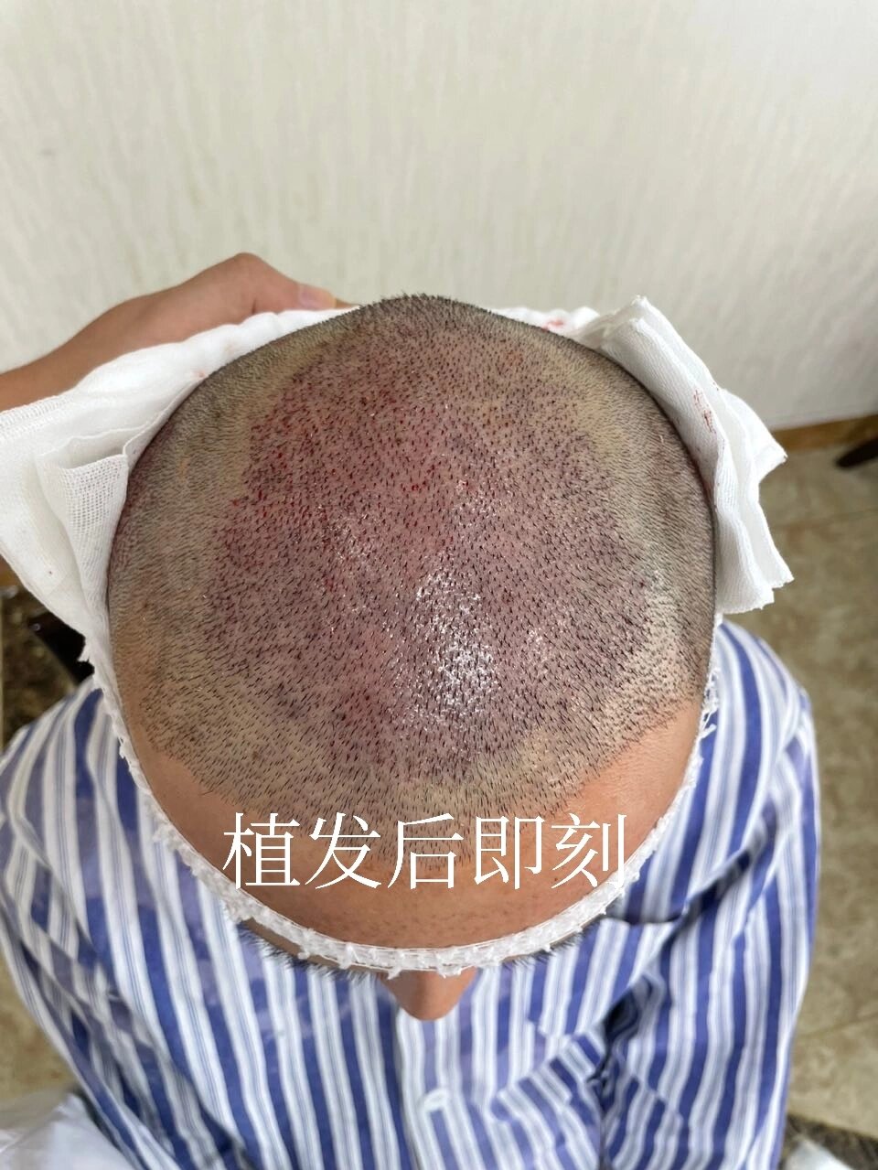 脱发的可以植发吗(脱发的人可以植发吗)