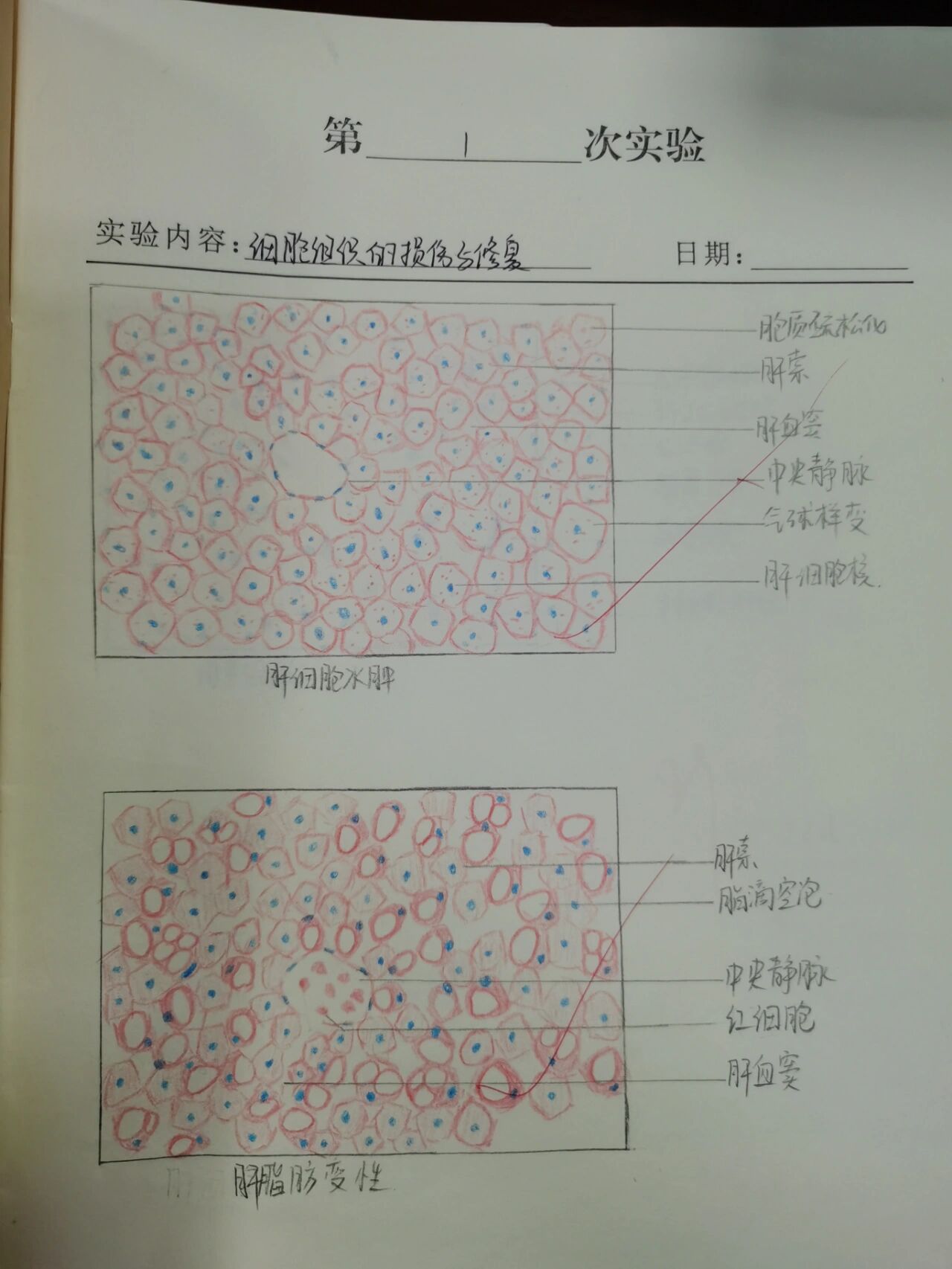 病理学切片 1:①肝细胞水肿②脂肪变性③肉芽组织 2:①慢性肝淤血早期