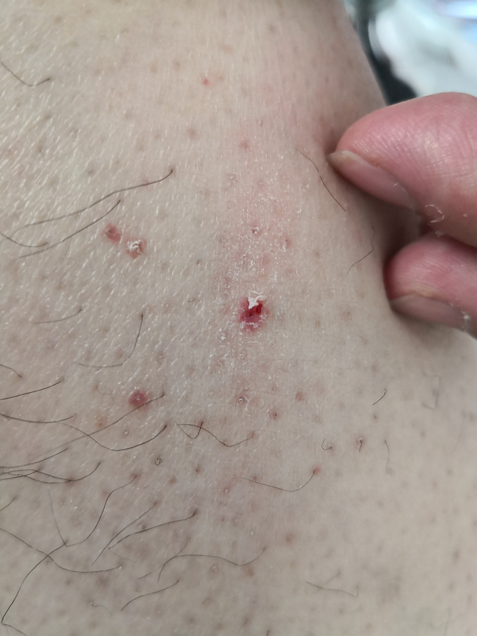 四肢散发鳞屑性斑点斑块症状.考虑点滴型银屑病症状#银屑病##牛皮癣