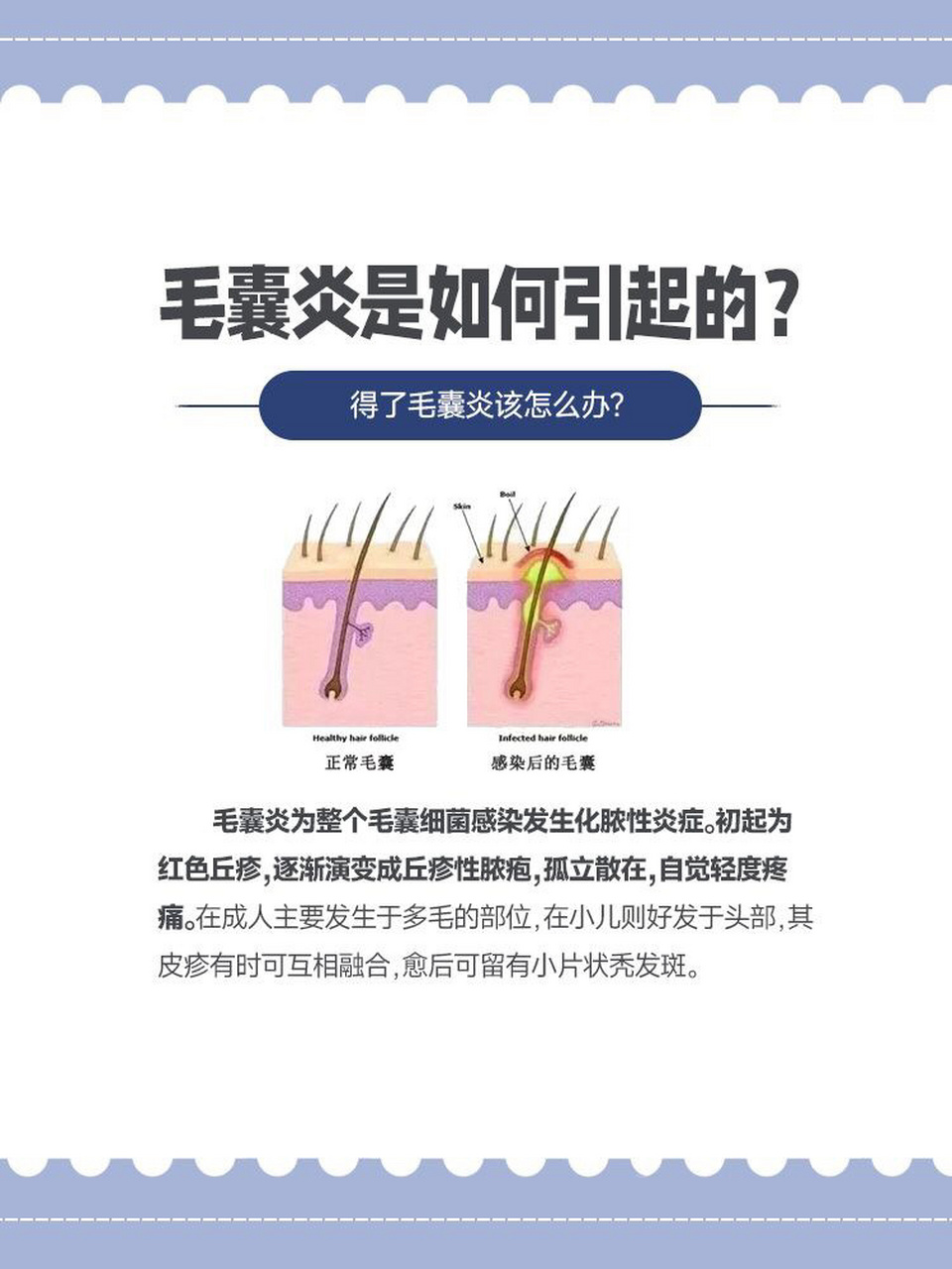 毒气痘痘是怎么引起的图片