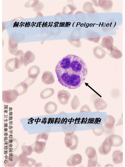 红细胞缗钱状排列图片图片