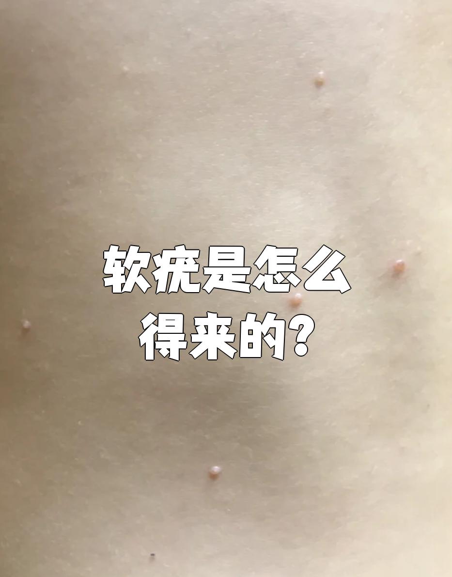 是由软疣病毒感染引起的皮肤病,主要表现为胸
