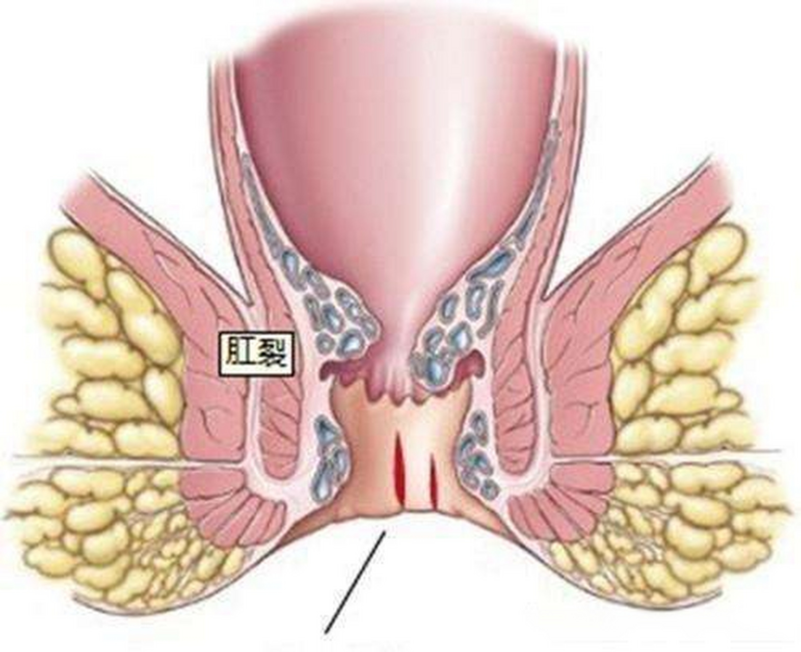 复兴中医肛肠:痔疮,脱肛,肛裂易诱发肛门松弛或肛管收缩性差 过节期间