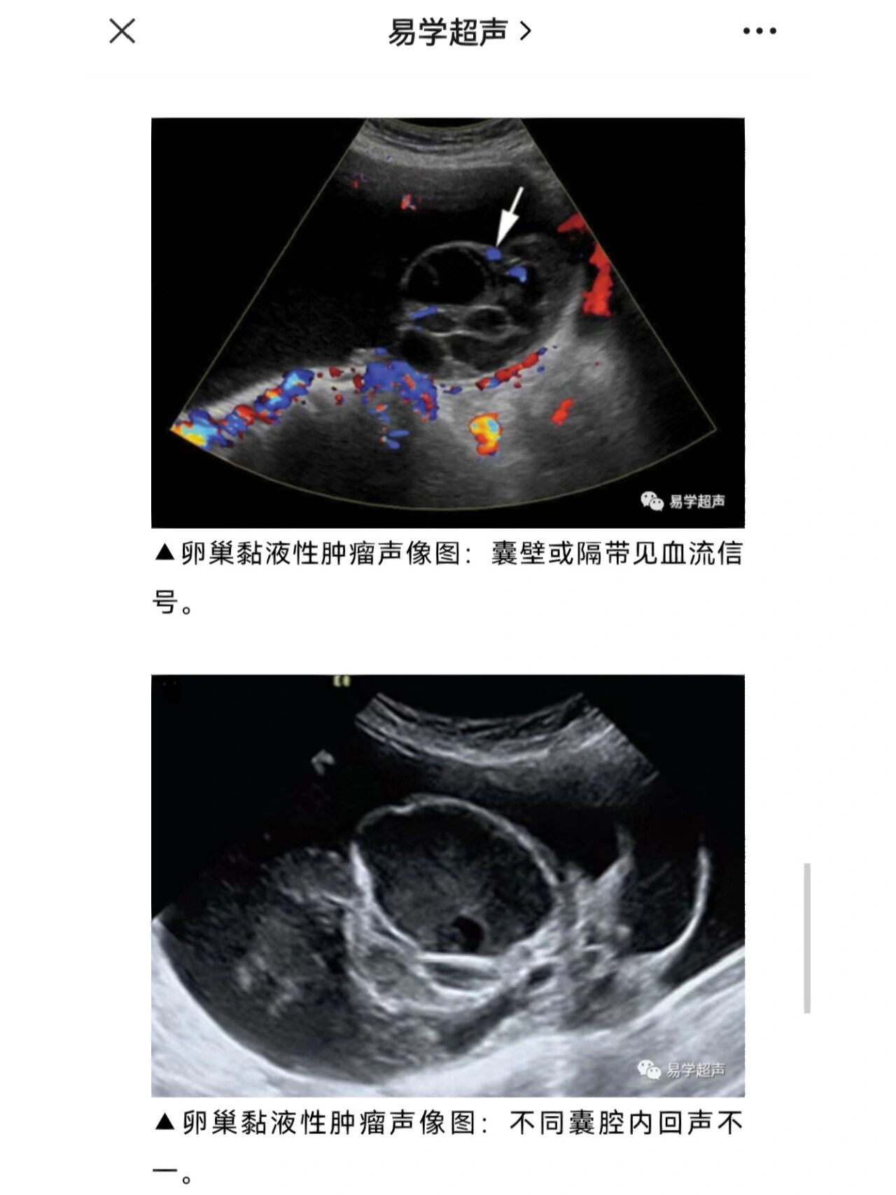 超声笔记-卵巢囊腺瘤 卵巢囊腺瘤包括浆液性和粘液性,浆液性更多见