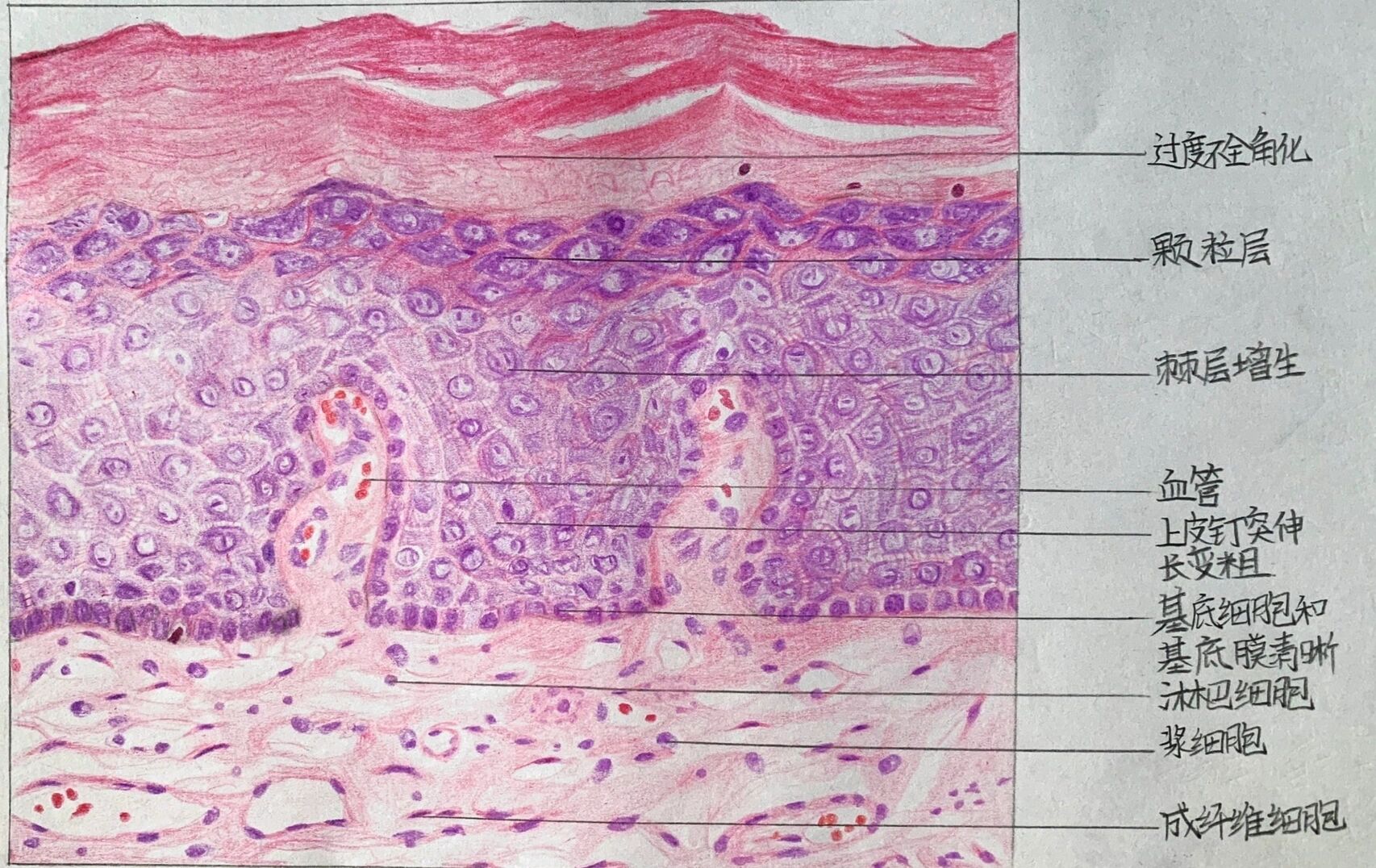 口组病绘图·口腔白斑,上皮单纯增生 不要忘记画出棘细胞之间的细胞间