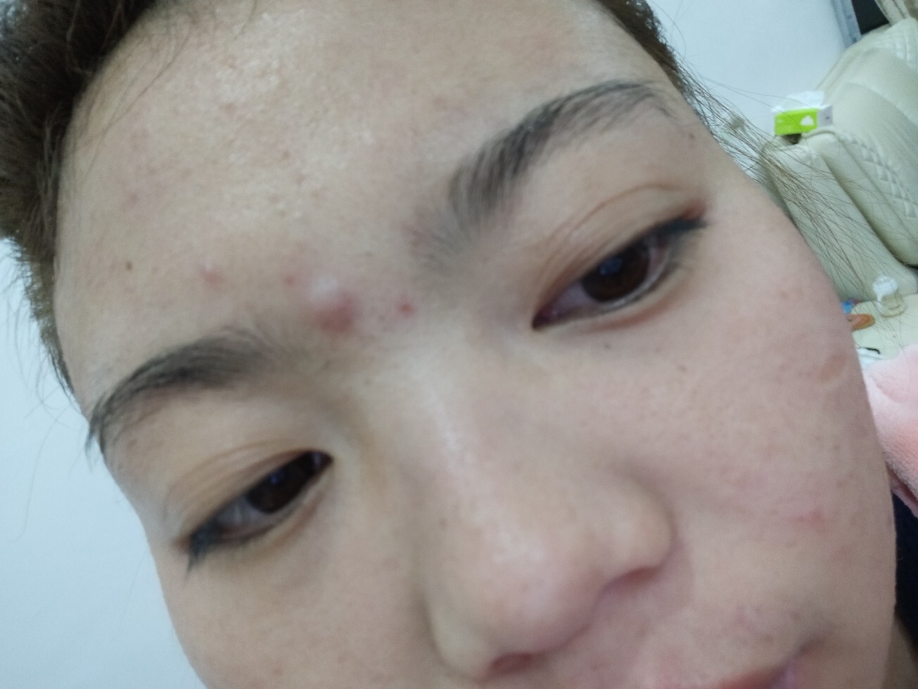 眉毛中间长了个东西,有知道怎么回事的吗