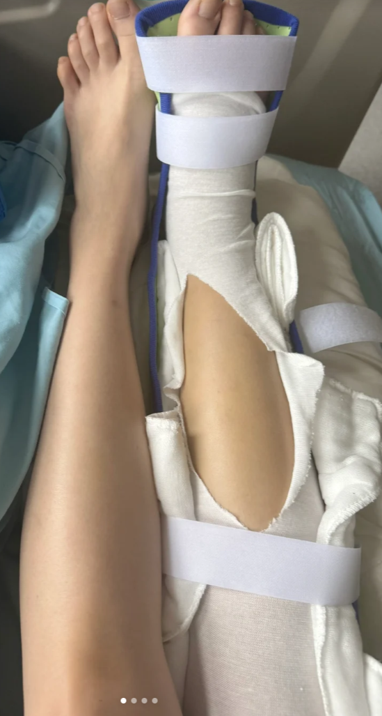小腿骨折选内固定还是外固定,主要看骨折的具体情况