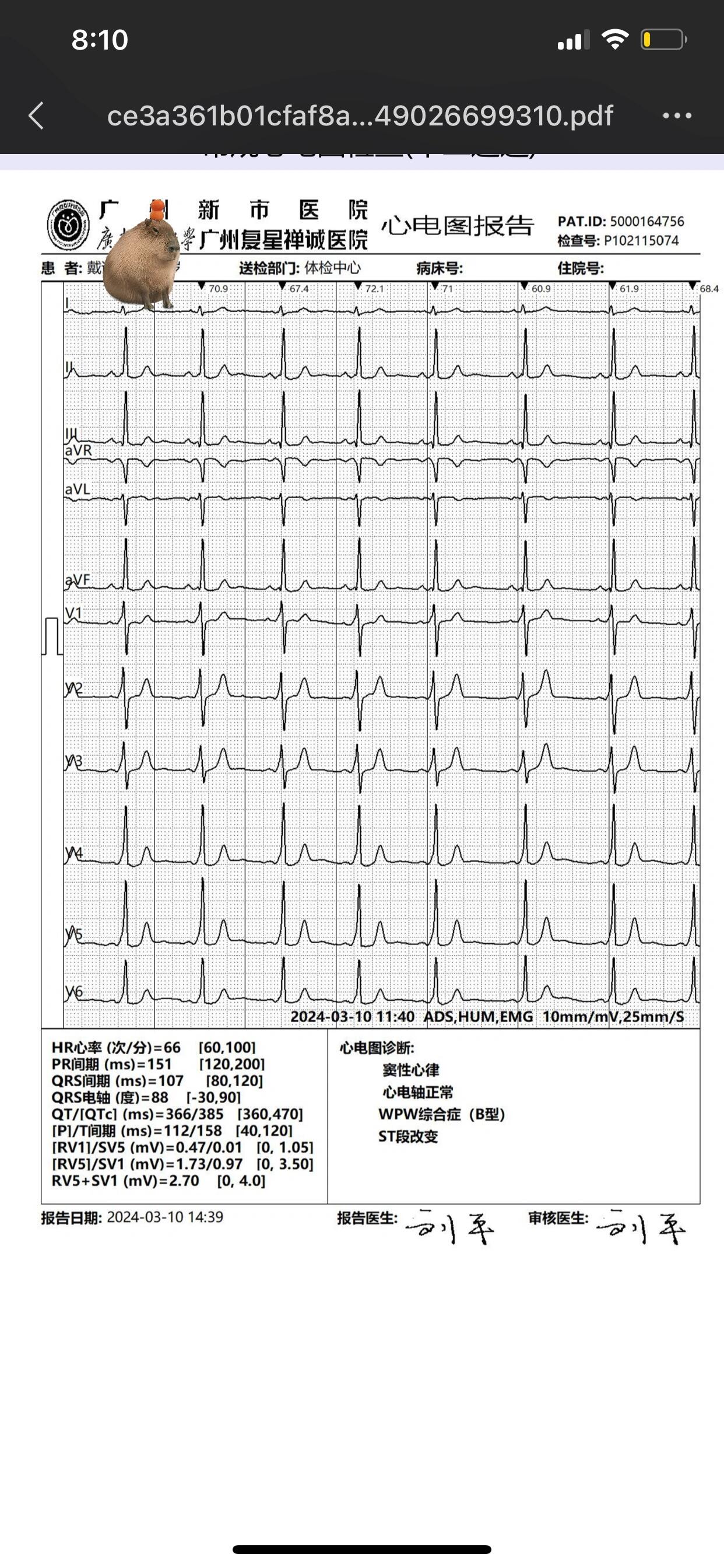 有人看得懂心电图吗 预激wpw综合征 有人看得懂心电图吗 我这是算严重
