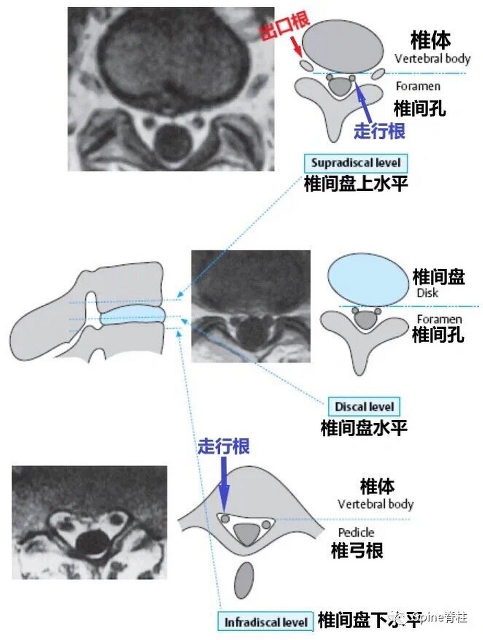 腰椎核磁图解图片