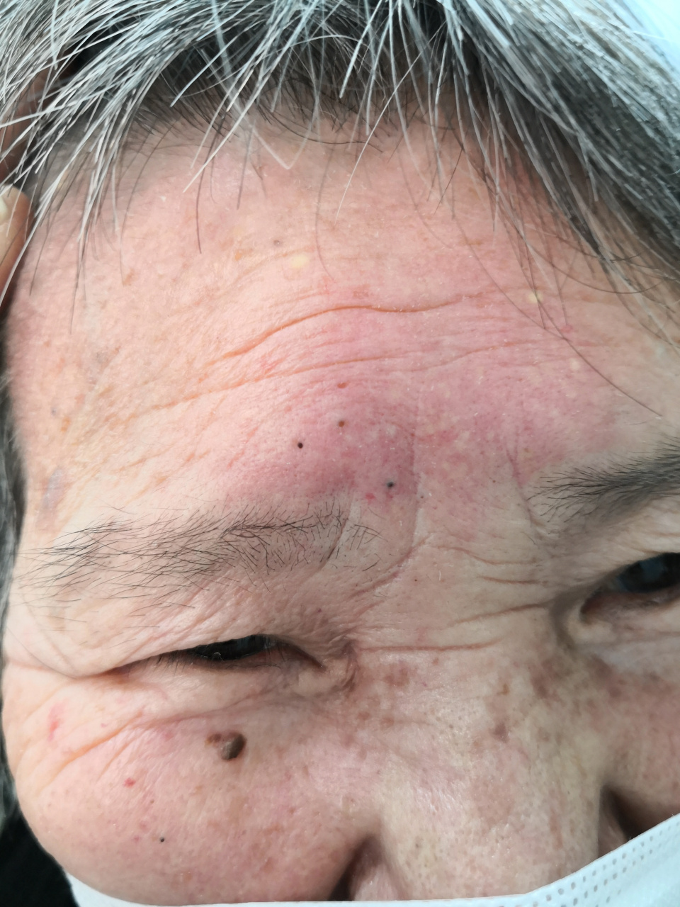 额头肿胀性红斑.#过敏