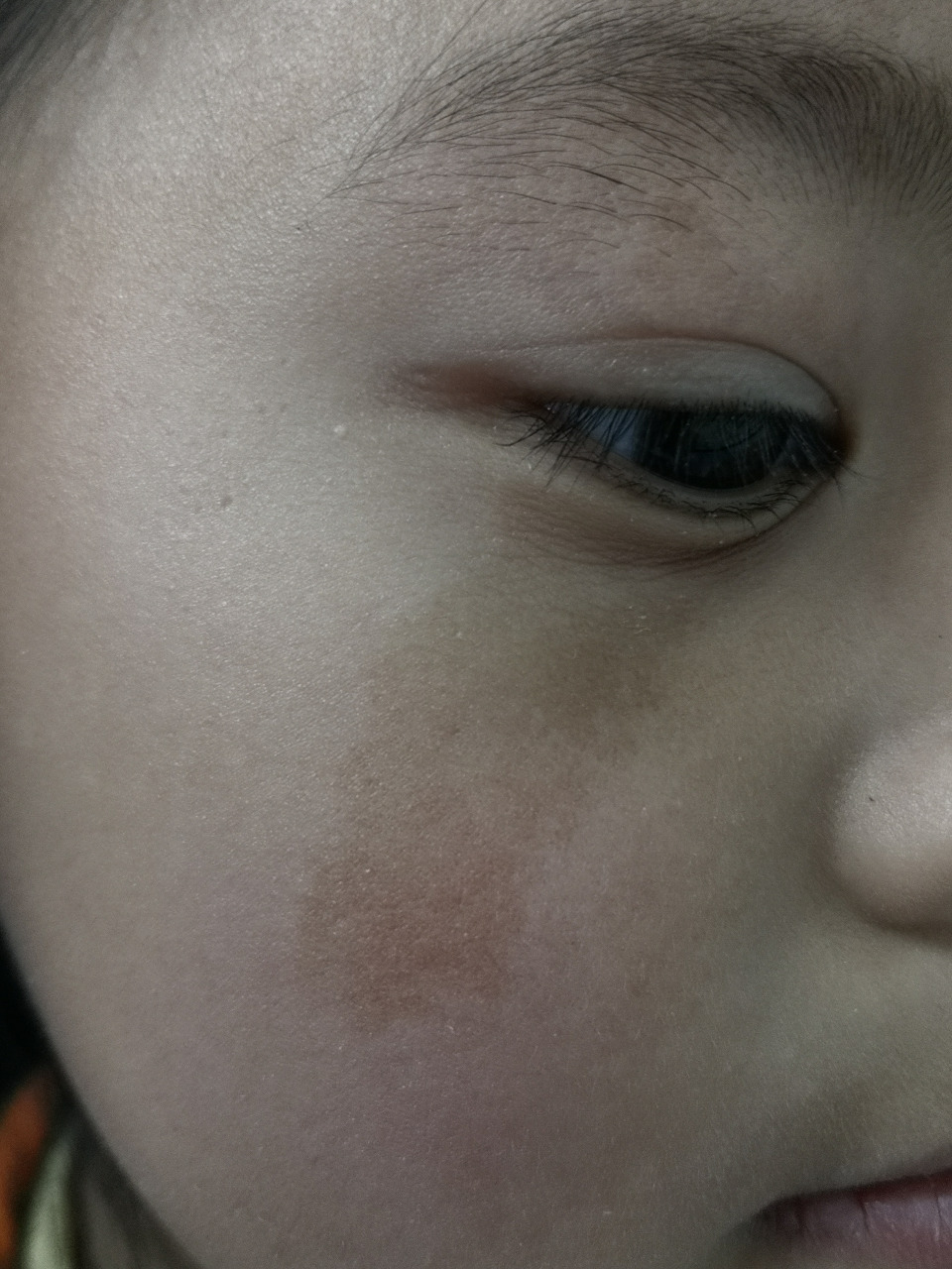 考虑咖啡斑.可以手术切除治疗.激光治疗容易出现反复.