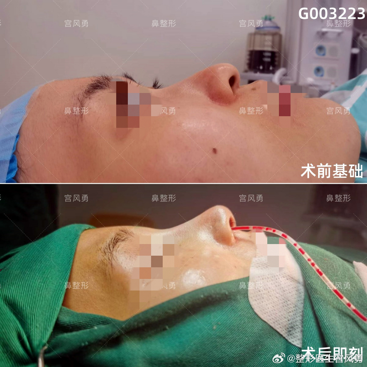 【箭头鼻】#老宫案例时间#  术前诊断:鼻尖下旋露鼻孔,下小叶悬垂,鼻