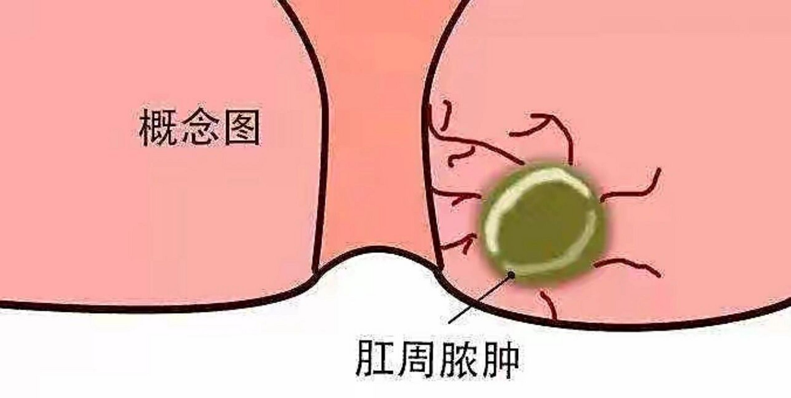 解析一:(发病过程)  第一篇小红98献给皮燕子 肛周脓肿 低位肛瘘,它