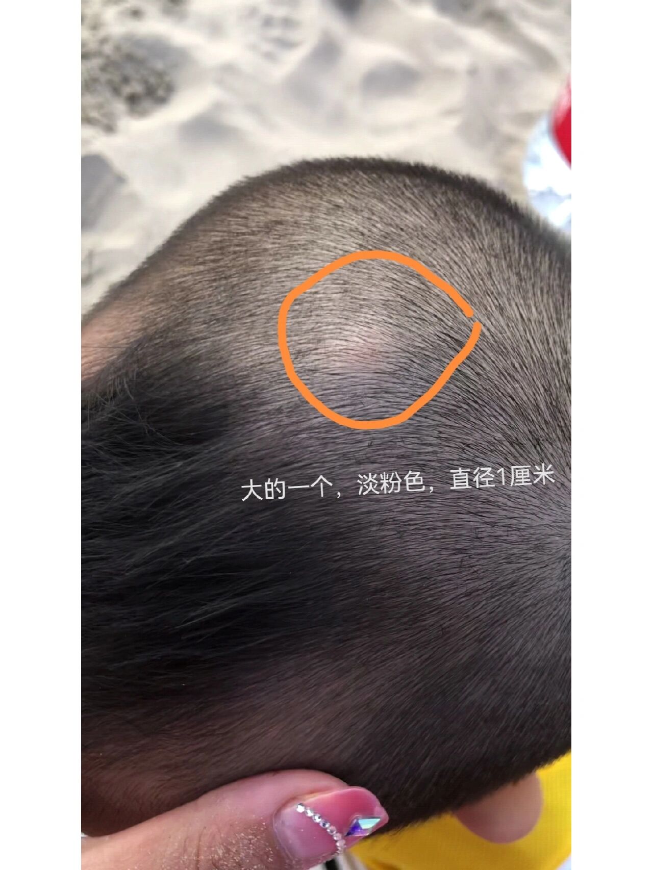 宝宝头上有个包?别紧张,可能就是蚊子咬的