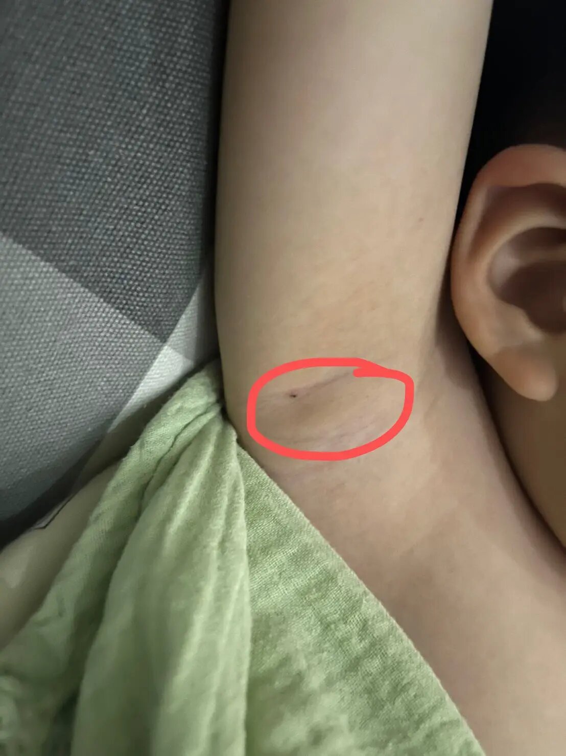 小朋友腋窝下面这个黑色点点是啥呢