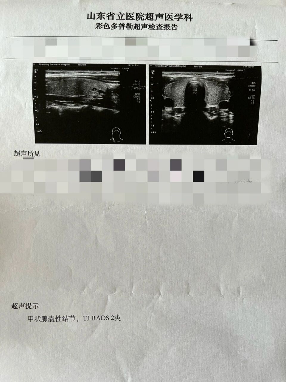 25岁 桥本氏甲状腺炎虚惊一场 9月1号公司组织体检 医生摸了摸我的
