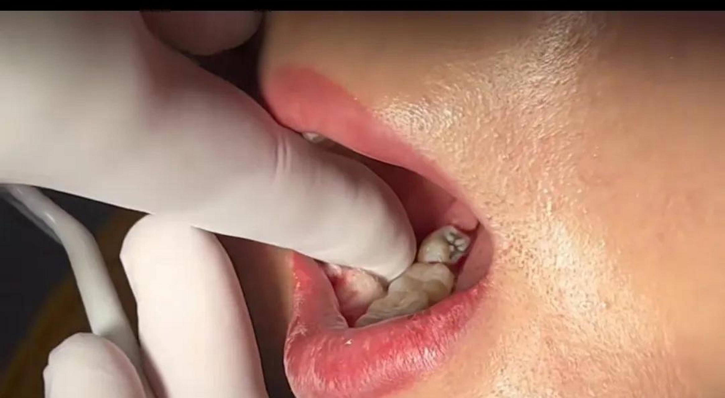 看着这洞好大好深,室友昨天花480块拔了颗智齿虫牙,社保报了300块.